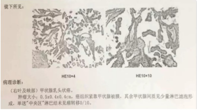 別慌，甲狀腺疾病還可以這樣投保！